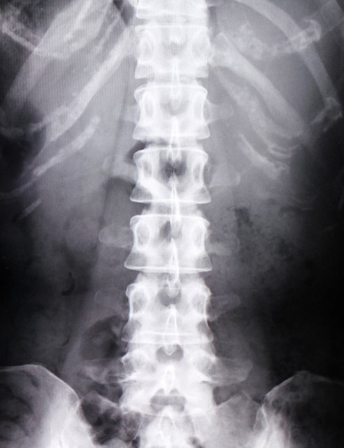 腰椎椎間板ヘルニアと痛みの関係